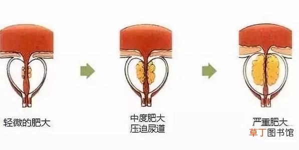 尿频的症状 尿频症状分析