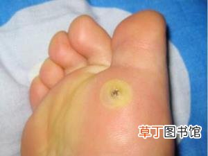 系带处长了锥状小肉芽 为什么长肉刺