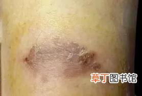 湿疹怎么引起的 湿疹为什么会加重
