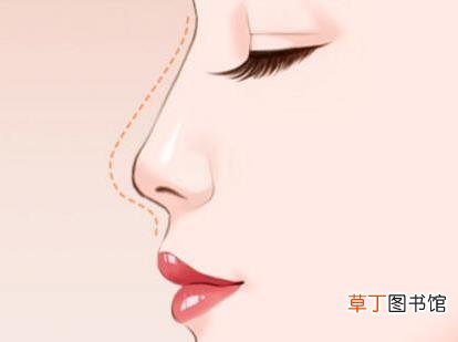鼻子假体取出来会很丑吗