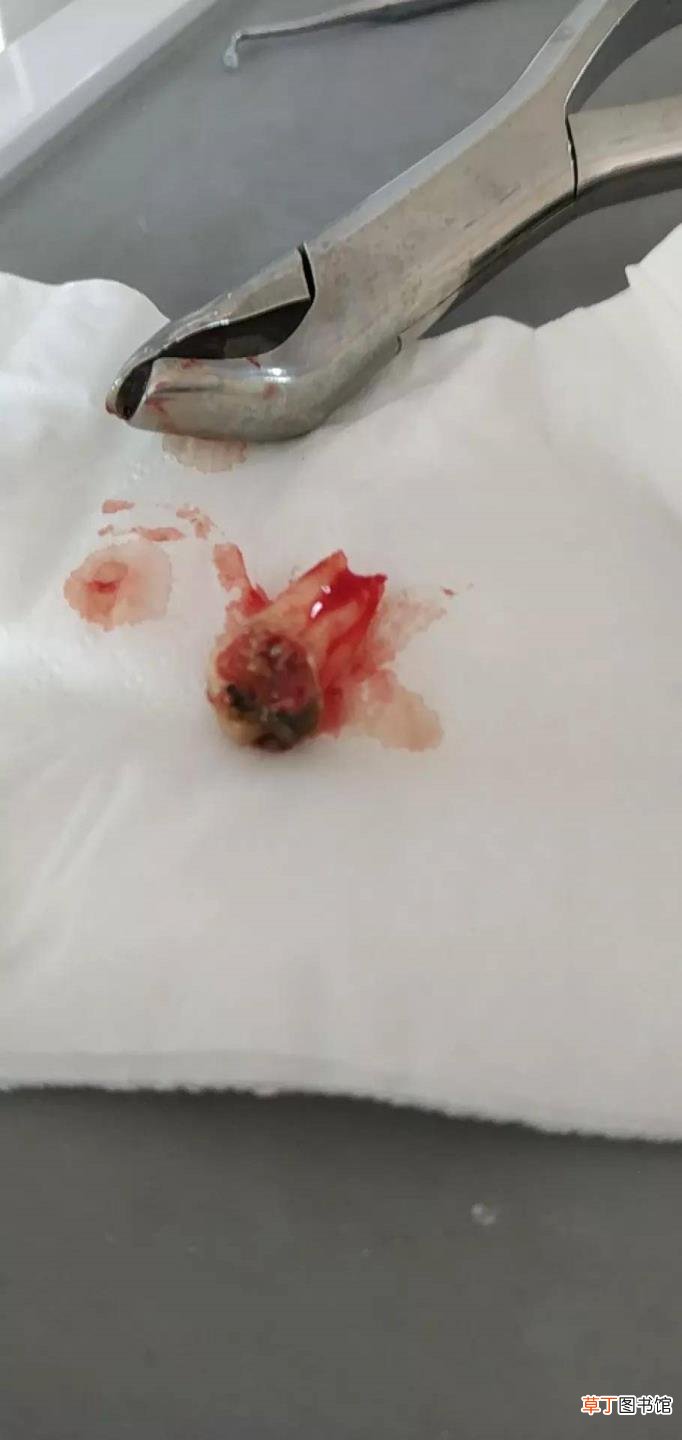 50不拔牙什么意思 为什么不拔牙