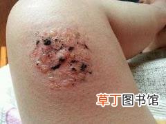 灸完艾灸后会发痒 为什么艾灸痒