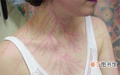 身上出现恐怖闪电疤痕 这可比哈利波特的酷多了 被雷劈后