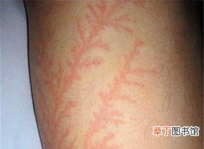 身上出现恐怖闪电疤痕 这可比哈利波特的酷多了 被雷劈后