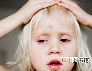 水痘的护理 出水痘怎样护理？