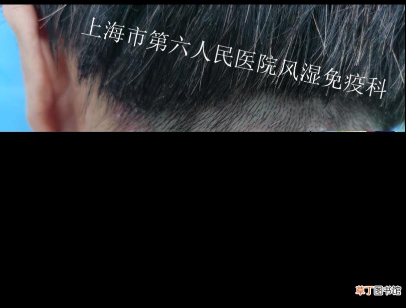 第二个脚趾头突然肿痛 脚趾为什么会肿