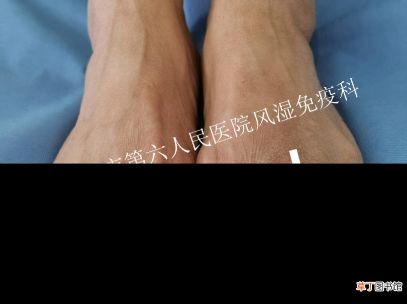 第二个脚趾头突然肿痛 脚趾为什么会肿