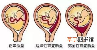 孕妇难产的原因 为什么会难产