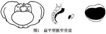 孕妇难产的原因 为什么会难产