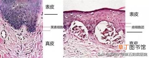 激光祛痣后留下粉色坑 为什么脸上长黑痣