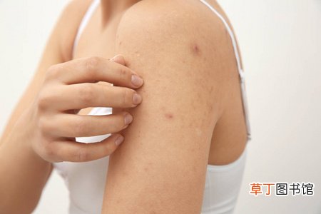 女人梦见自己脸上长痘是什么意思