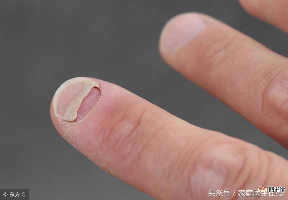 指甲上下分层撕开了很薄很软 指甲为什么会分层