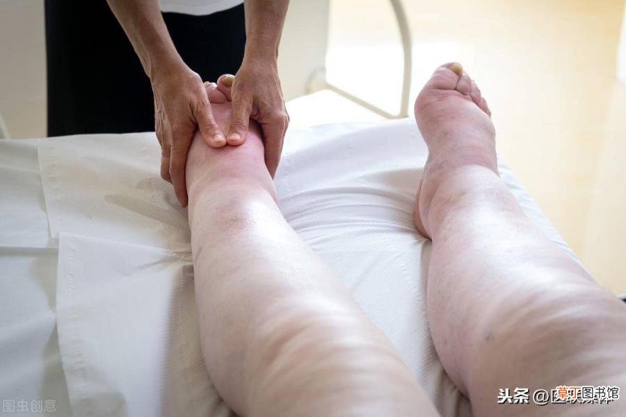 女性经常水肿是什么原因 为什么小腿会浮肿