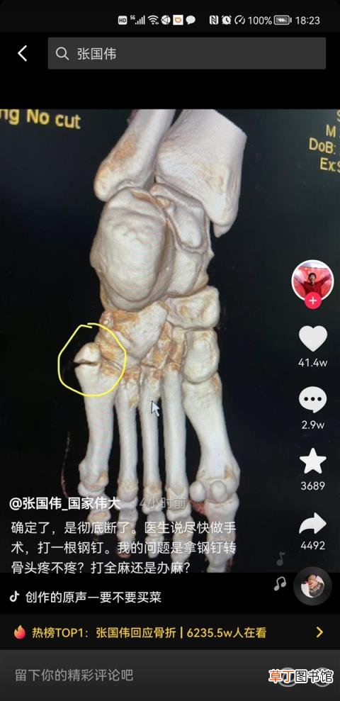 网友：等你回来龙吸水 跳高名将张国伟训练过猛致骨折