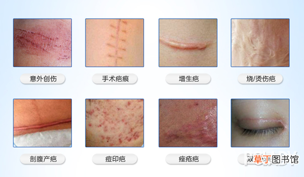 除疤产品 有哪些好用的祛疤膏