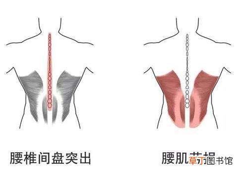 腰肌劳损吃什么药 能治疗腰肌劳损的中成药大全