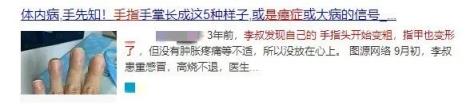 一查竟是癌！出现这些异样或是大病信号 手指变粗、指甲变形