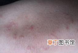 湿疹怎么才能根除 怎么做才能彻底治愈湿疹