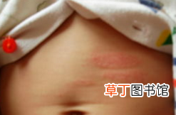湿疹怎么才能根除 怎么做才能彻底治愈湿疹