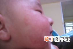 湿疹怎么才能根除 怎么做才能彻底治愈湿疹