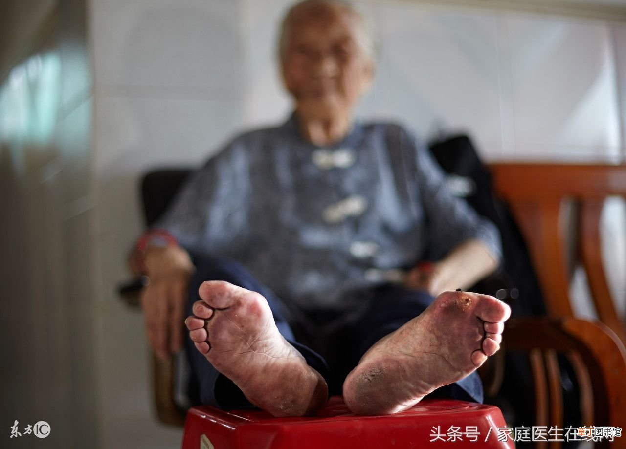 什么是鸡眼 鸡眼是什么东西？