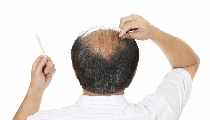 梦见头发稀少是什么意思 梦见头发稀少有什么预兆