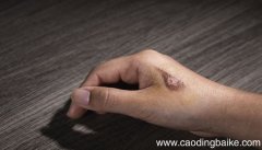 梦见烫伤是什么意思 梦见烫伤是什么预兆