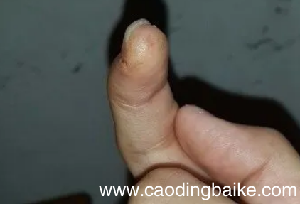 手指缝脱皮是梅毒吗 为什么手指缝中间会掉皮