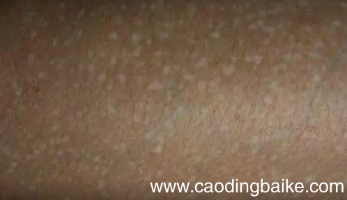 突然长出白斑是什么原因 刚长出来的白斑图片