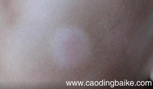 突然长出白斑是什么原因 刚长出来的白斑图片