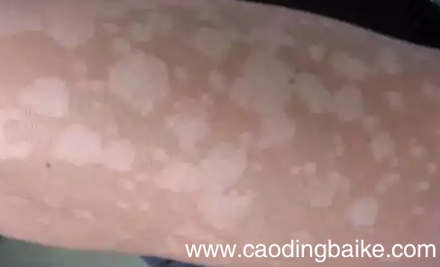 突然长出白斑是什么原因 刚长出来的白斑图片