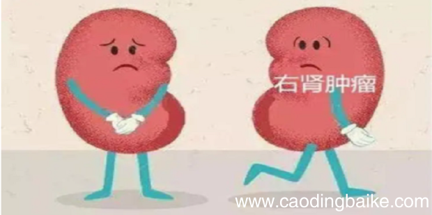 肾癌的五大临床症状