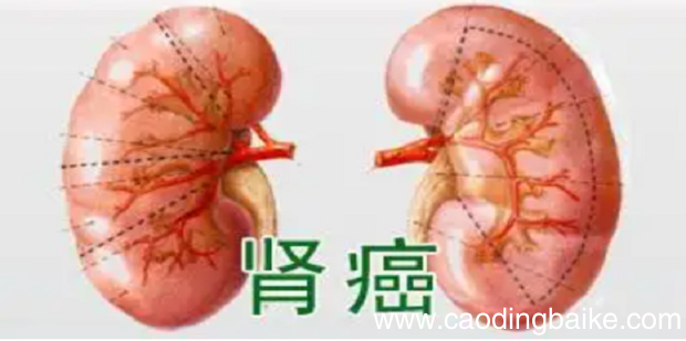 肾癌的五大临床症状