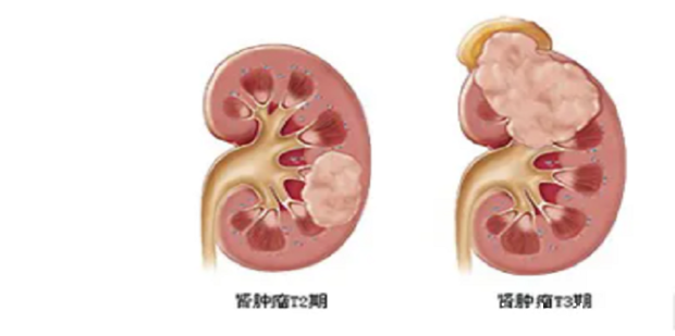 肾癌的五大临床症状