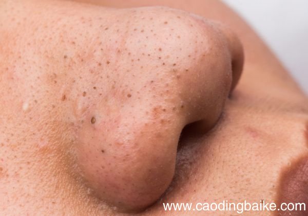 果酸怎么去黑头 果酸去黑头有用吗