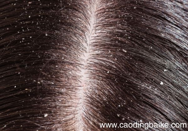 头皮痒是什么原因 为什么头皮会痒