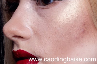 闭口粉刺是怎么形成的 为什么有闭口粉刺