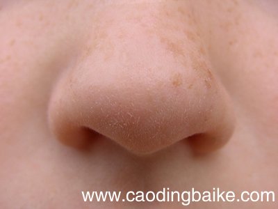 闭口粉刺是怎么形成的 为什么有闭口粉刺