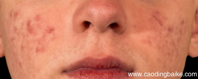 右脸颊长痘需要排毒吗右脸颊长痘是什么原因