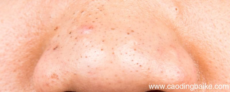 鼻子黑头多的原因 为什么鼻子上有黑头