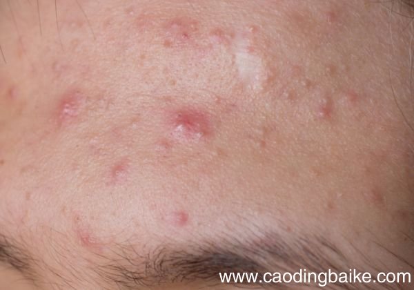 额头上长粉刺是什么原因 额头上为什么会长粉刺