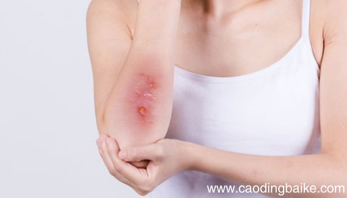 活力霜为什么发热和辣活力霜用后发热是什么原因