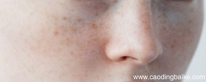 分享几个淡斑小妙招 淡斑小妙招有哪些