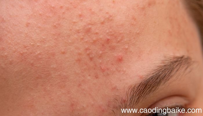 判断脸上有角质的方法 如何判断脸上是否有角质