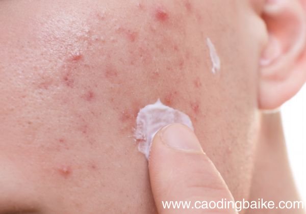 粉刺瘤的危害有哪些 粉刺瘤会带来哪些伤害