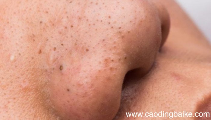 挤黑头挤出来的白色东西是什么挤黑头挤出来的白色物质是什么