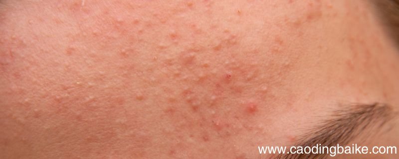 脸上长粉刺需要注意什么 脸上长粉刺的注意事项