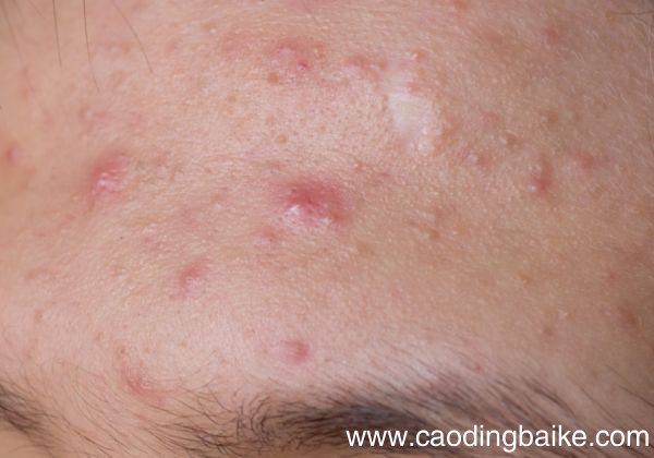 痤疮是什么 痤疮的症状有哪些