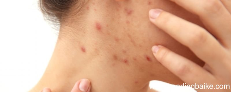 痤疮是什么 痤疮的症状有哪些