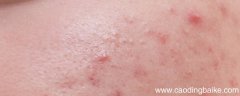 安安粉刺露好用吗 安安粉刺露是什么
